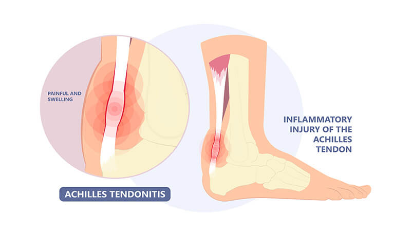 Home treatment for achilles tendon clearance pain